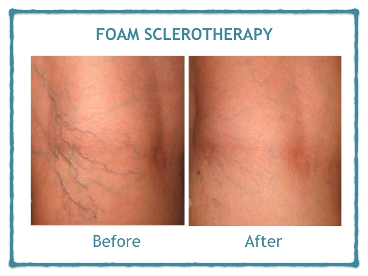 Foam Sclerotherapy Vein Treatment Dr Avinash Katara Minimal Access