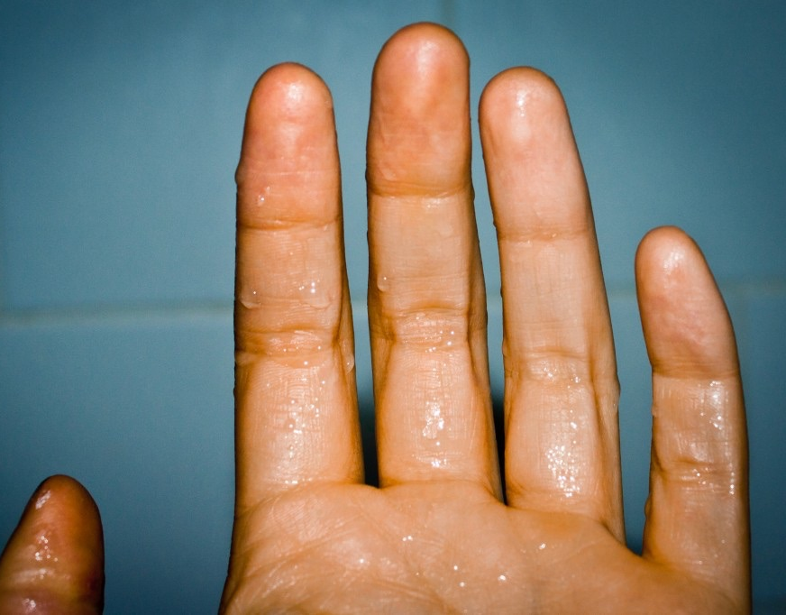 От чего потеют руки. Обваренное палец человека. 4 На пальцах врачей.