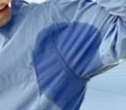 palmar hyperhidrosis treatment