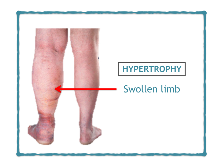 Complications Of Varicose Veins Dr Avinash Katara Minimal Access Surgeon